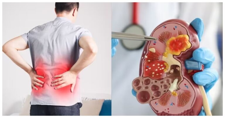 How long can a person live with 1 kidney?